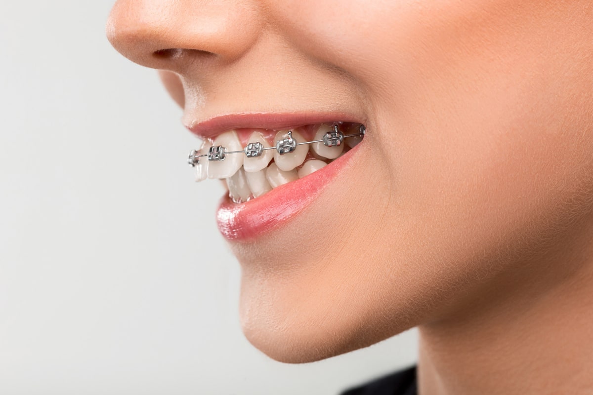 بیمه تکمیلی ارتودنسی دندان