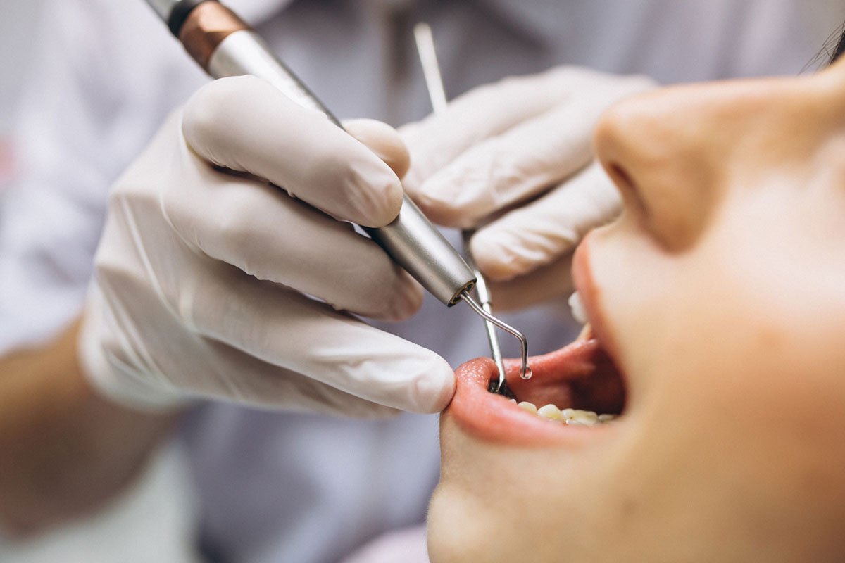 هزینه عصب کشی دندان با بیمه تامین اجتماعی