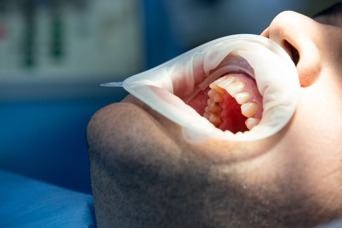 هزینه عصب کشی دندان با بیمه تکمیلی