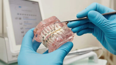 هزینه ارتودنسی با بیمه تکمیلی